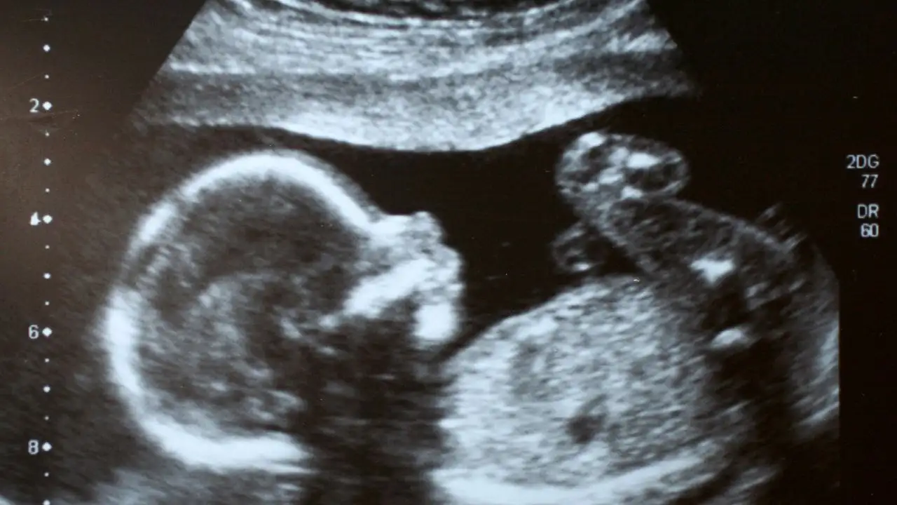Does a Thickened Nuchal Fold Mean Down Syndrome